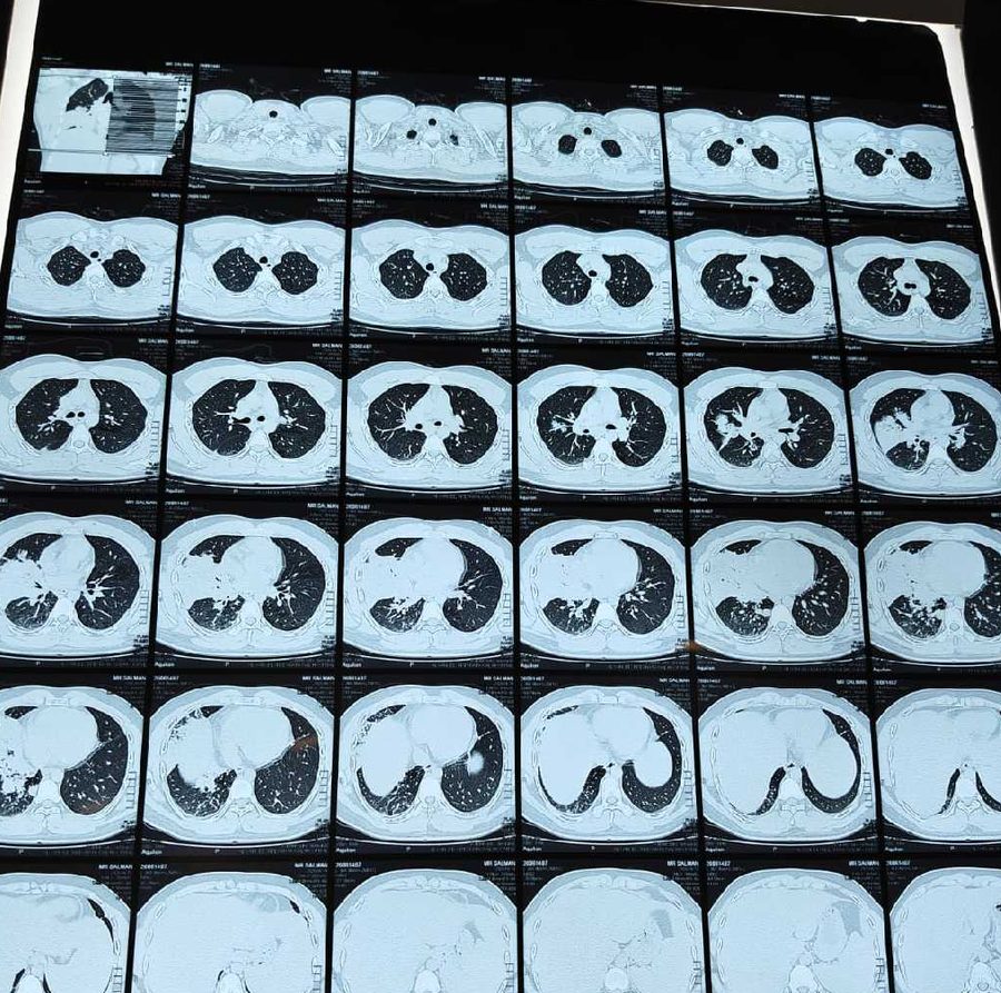HRCT chest showing right middle lobe opacity in vape-associated lung injury