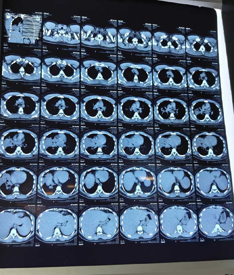 Additional HRCT chest images showing pulmonary opacities in vape user