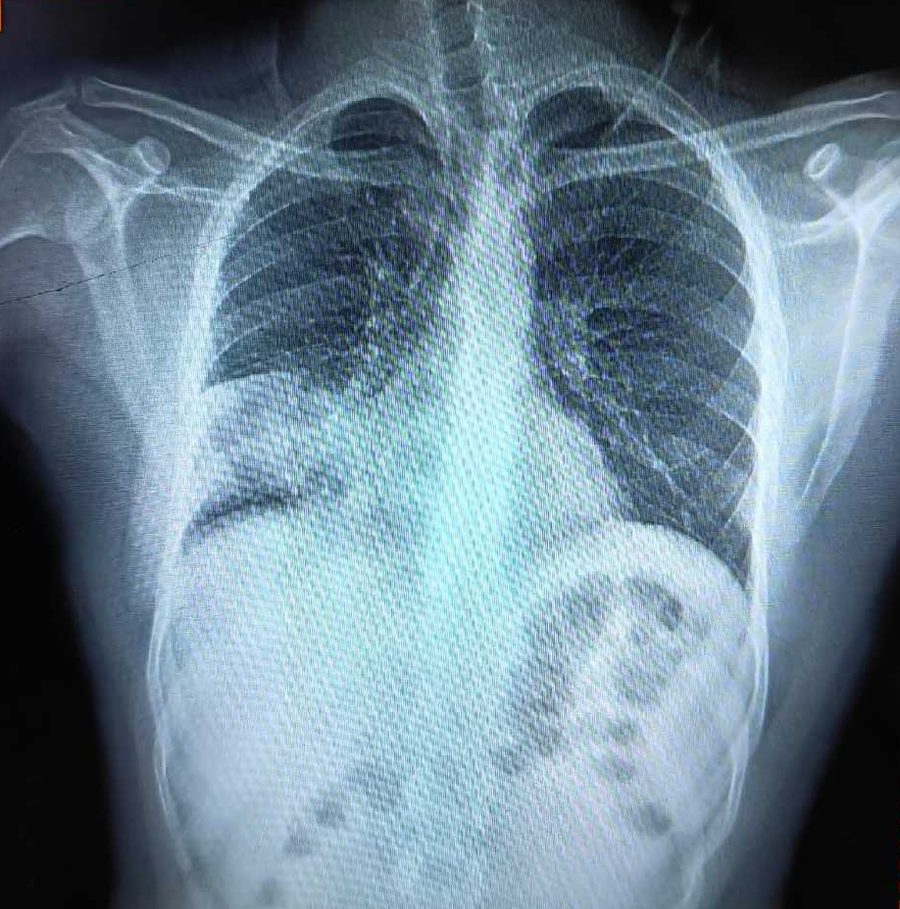 Chest X-ray showing pneumonia in young vape user at IRC Islamabad